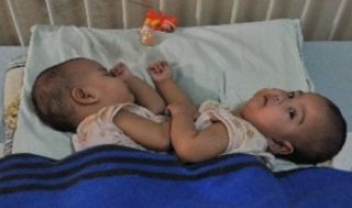 Bayi kembar siam. Ilustrasi (Republika)