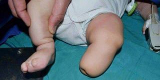 Bayi terlahir cacat di Suriah. (islammemo)