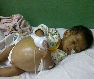 Fariel, bayi berumur 10 bulan menderita penyakit sirosis hati.  (Bagus/dpudt)